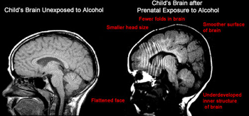 Image: MR comparison showing the brains of two children and the effects of alcohol exposure during pregnancy (Photo courtesy of the Children’s Research Triangle).